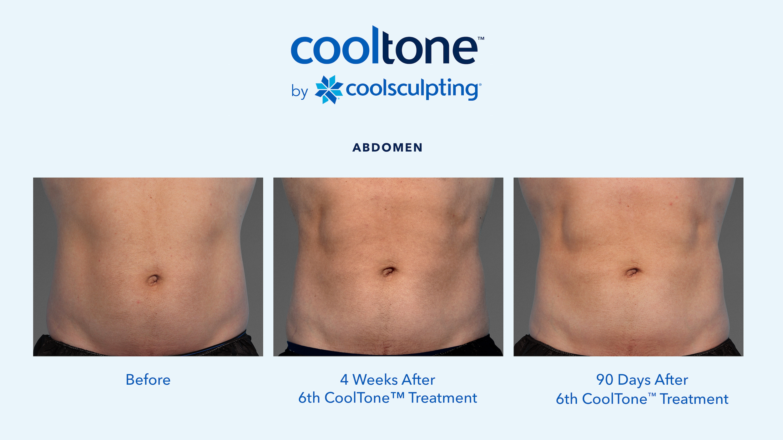 CoolTone Before & After Results